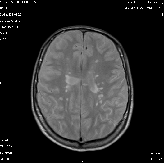 МР-томограммы головного мозга в аксиальной проекции